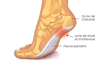 L’hypertension artérielle